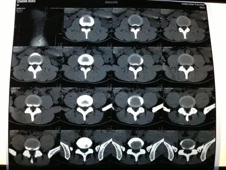 腰椎ct检查