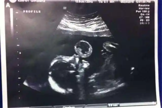 怀孕5个月四维彩超检查, 宝宝完全不配合, 医生直言: 这娃要不得_胎儿