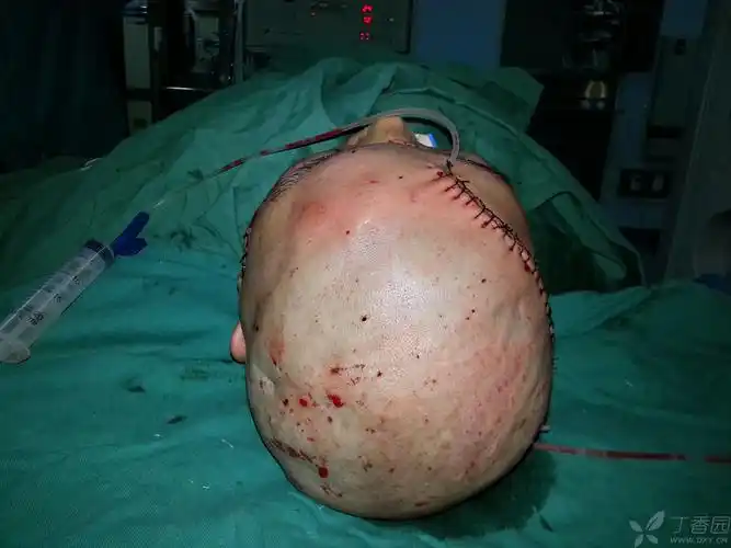 【讨论】头皮撕脱伤再植 [精华] [病例帖]