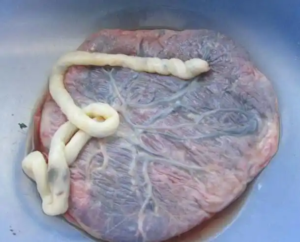 孩子出生后胎盘怎么处理家属胎盘是补品要带回家炖来吃