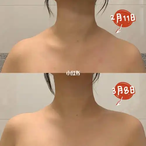 周六野斜方肌练习27天对比