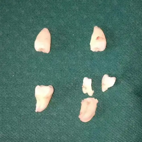 拔掉的牙齿