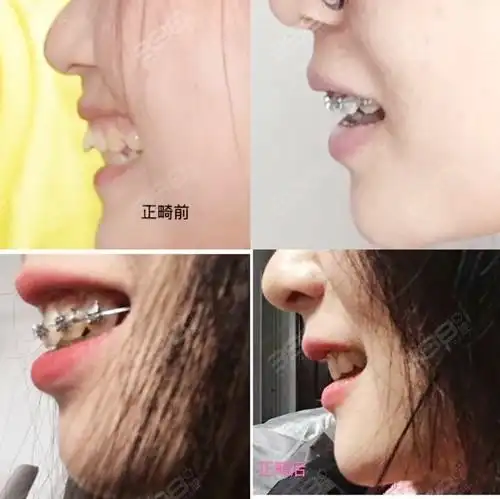 带牙套112月变化图矫正效果堪比整容居然改变了脸型