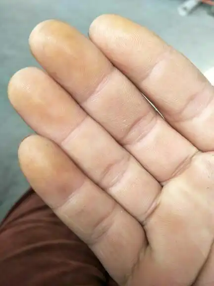 看看我手指发黄是什么原因呀?