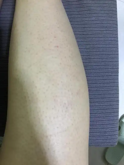 求助仙女们告诉我腿上毛孔粗大要怎么办图片可能引起不适慎入