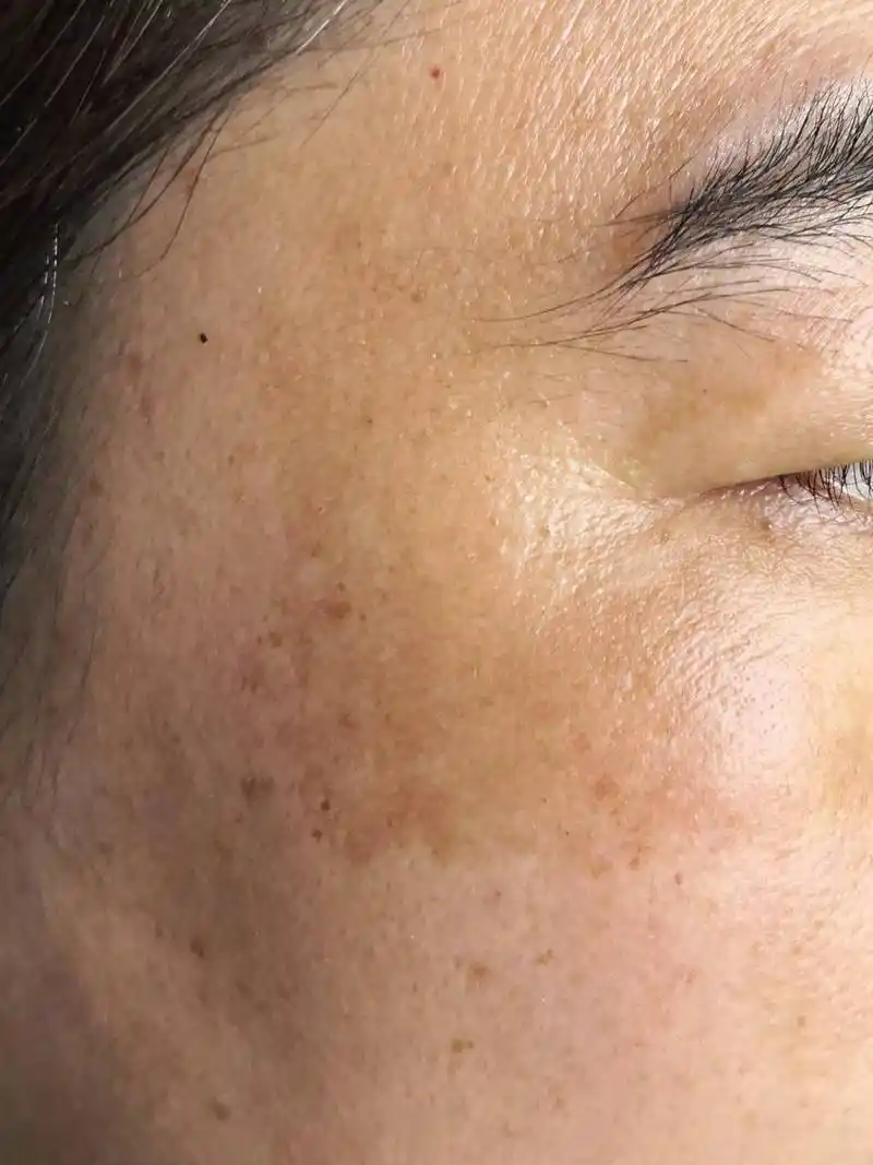 祛黄褐斑# #厦门皮肤科医院# 脸上长黄褐斑多见于中青年女性,病液很