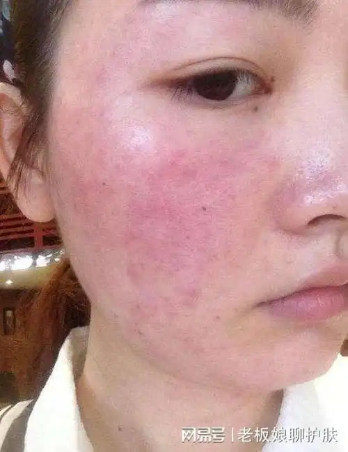 皮肤缺水的体现怎样才是有效补水①