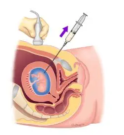这种检查是一个小手术你所说的睾丸穿刺,好像是说的一种治疗方法,从你