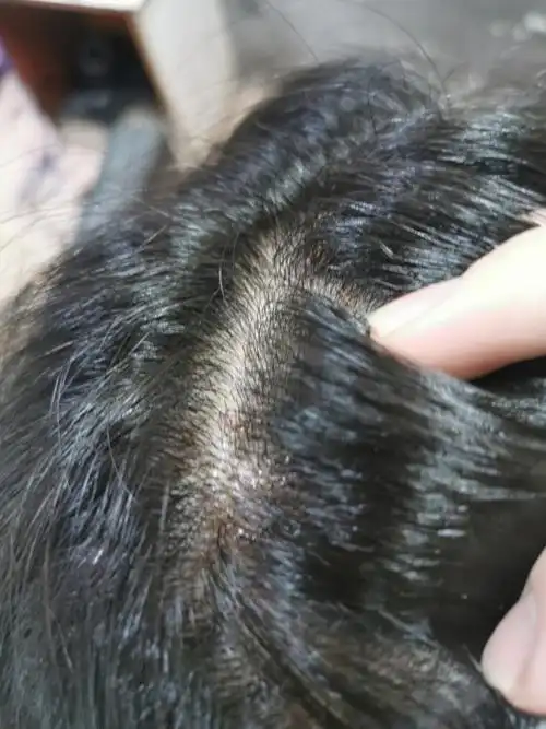 晚上基本不会洗头大多数是在白天洗头的为什么头皮还会有湿疹?