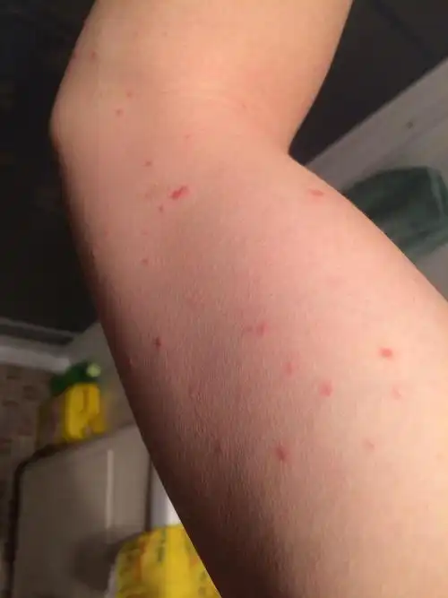 身上脖子上胳膊上腿上都长这样的红点有点痒…求高人看看这是什么病啊