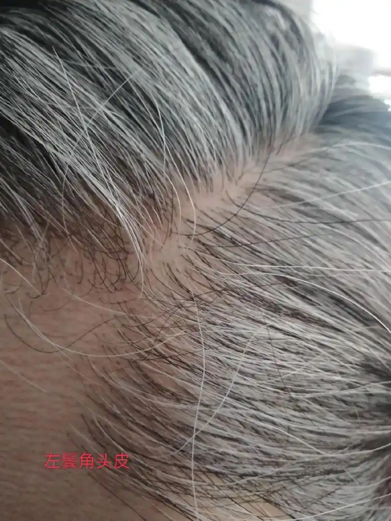 梳头打卡第95天.头皮颜色没有那么白了,比一个月前深点了.以 - 抖音