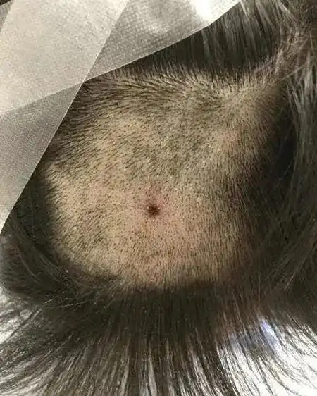 南昌:头皮发麻!一宝宝的头皮上竟出现了一个"大虫子",家人吓坏了!