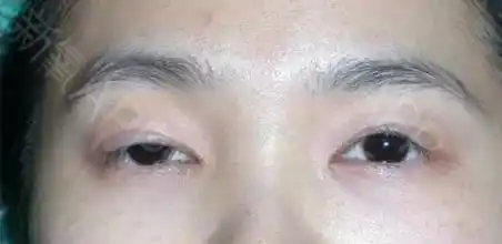 上睑提肌无力