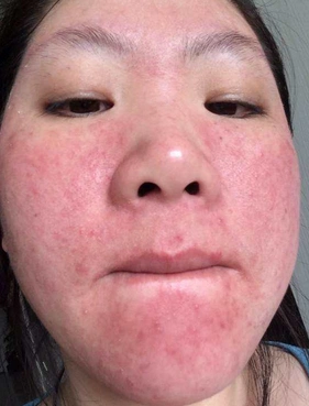 激素皮炎导致的脸干怎么办激素脸干是怎么回事