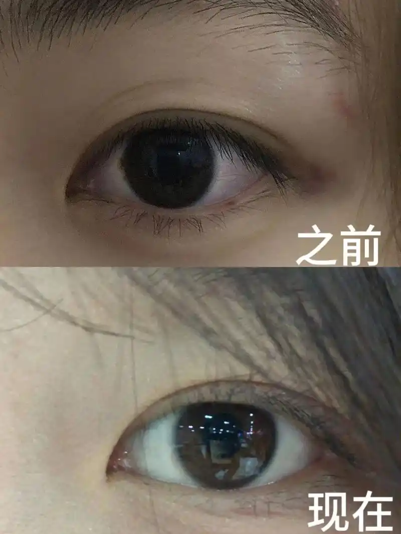 记录:改善红血丝的第39天.眼睛一直很红,休息只能消一点,后 - 抖音