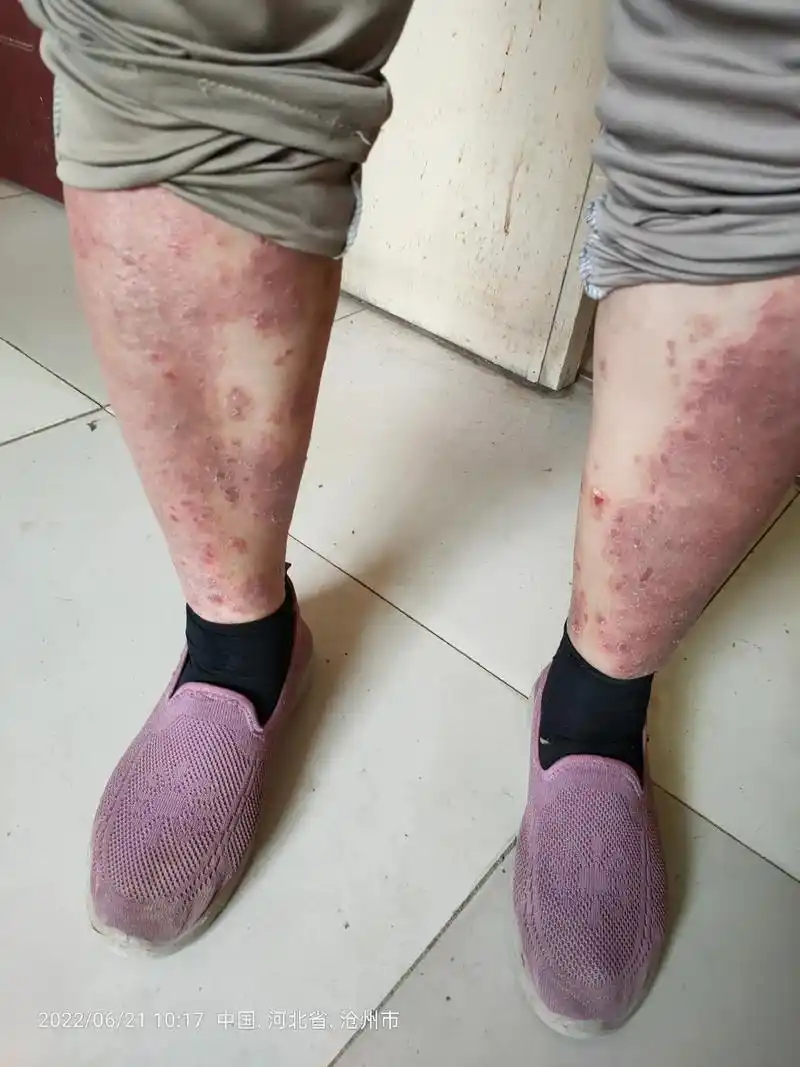 牛皮癣患者吃了三副药和四副药的对比,以中药照片为