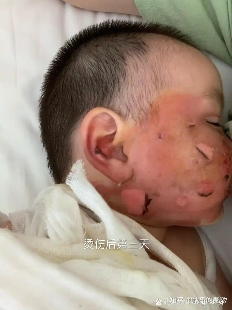 记录我一岁的宝宝被开水烫伤脸蛋
