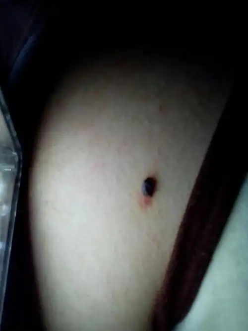 这颗痣有没有危险,最近发现它变大而且仔细观察好像是许多小痣而且