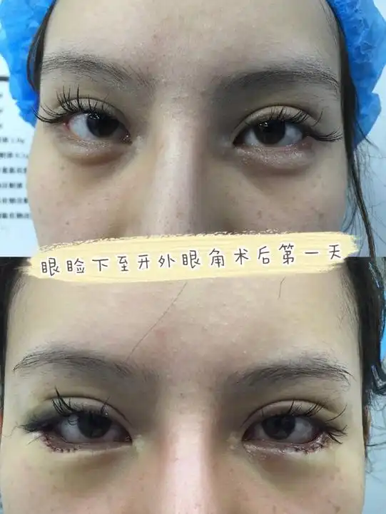 "下眼睑下至"是什么手术?安全吗?效果如何?正确认识这项手术