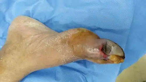 预防糖尿病足截肢从用中药方泡脚开始