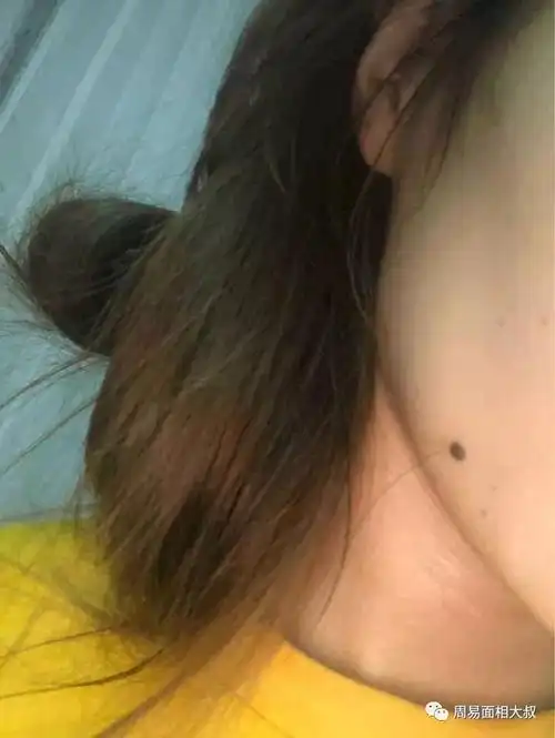 痣上面长毛有什么含义吗