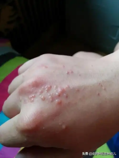 「手部湿疹」你是否也有这样的社交障碍手?