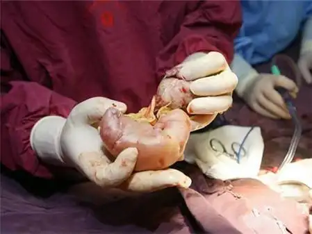 重疾险保险高血压 高血压重疾险