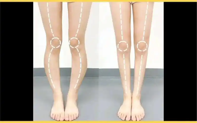 直腿变弯腿 这些习惯中招了没