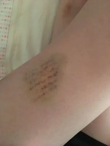 用手怎么捏的?伤成这样,冬天拖鞋隔着裤子都踹出鞋底印