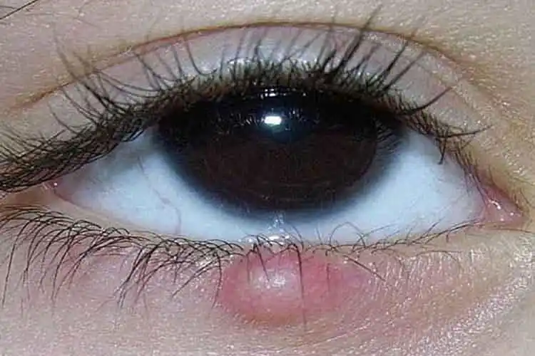 眼睑炎的症状图片_有来医生