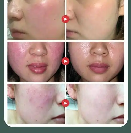 京品优选敏感肌修护霜起疙瘩红肿脱皮干痒急救脸过敏脸过敏修复乳植贝