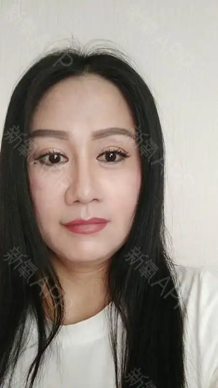 自体脂肪面部填充