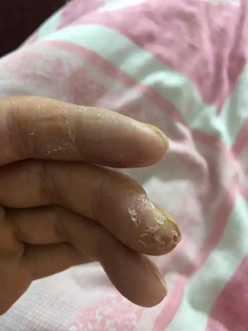 手指,手掌,大拇指上,起先里面密密麻麻起小水泡,又很痒,脱皮,还干燥裂