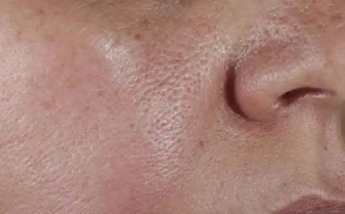 脸上毛孔粗怎么办简单收缩毛孔(如何改善毛孔粗大?