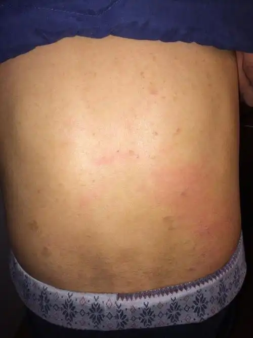 为什么后背长这么多这些,是不是因为冬天爆擦的原因,有点痒,越抓越多0