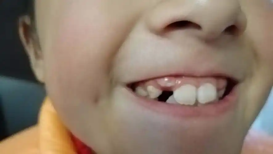 8岁女孩长牙齿问题!