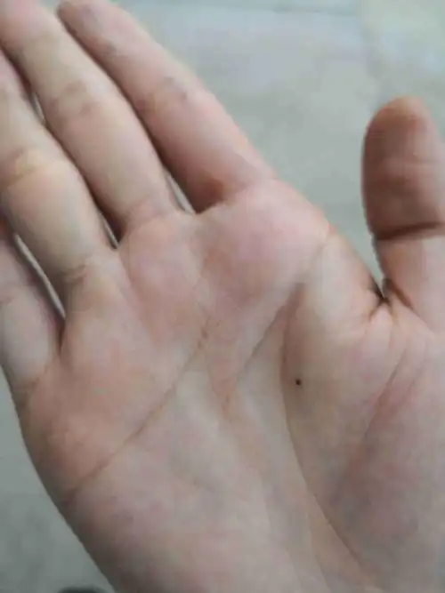 这两个月手掌突然长了一颗痣,好不好啊