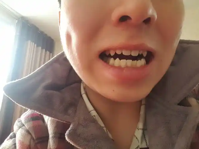 虎牙特别尖经常咬破嘴里的肉然后溃疡该怎么办