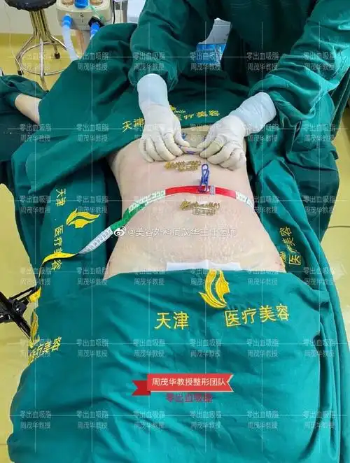 吸脂##腰腹吸脂##腰腹环吸