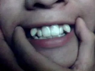 我的牙齿有两颗龅牙怎么办?很突出