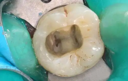 欧罗德卡初体验--一例髓腔根管部分钙化的下颌第一磨牙的治疗