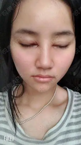 埋线双眼皮 开内眼角 术后1天
