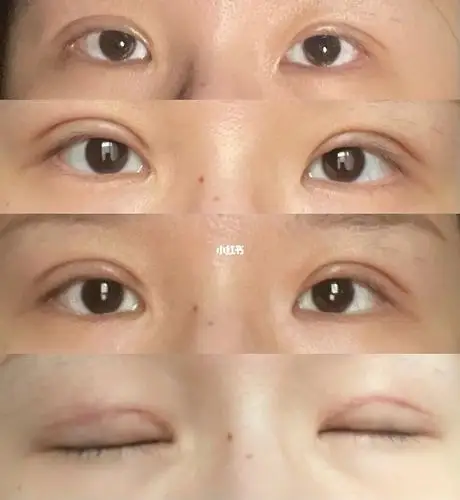 双眼皮手术后第三周