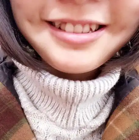 为什么别人家的虎牙长得那么好看-一颗小梅菌