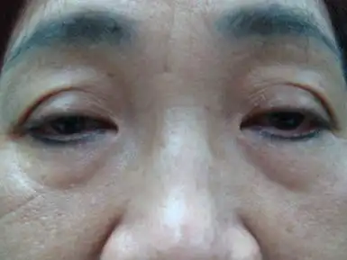 我只想做个双眼皮而已,叫我去皮去脂是什么鬼?