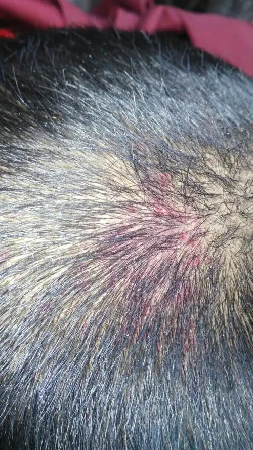 头皮上有红斑,不疼不痒,是怎么回事,请专业人员解答