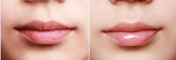 嘟嘟唇打多久恢复自然