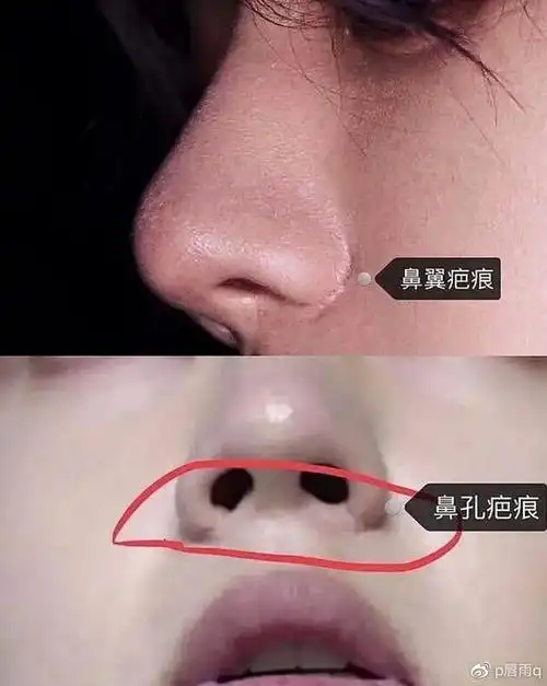缩鼻翼会留疤吗?如何避免?
