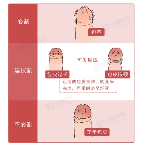 什么程度需要做手术?建议男生们都看看_吻合器_医生_感觉