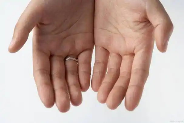 出现肝掌和蜘蛛痣是肝不好的信号吗?建议养好做好这3步